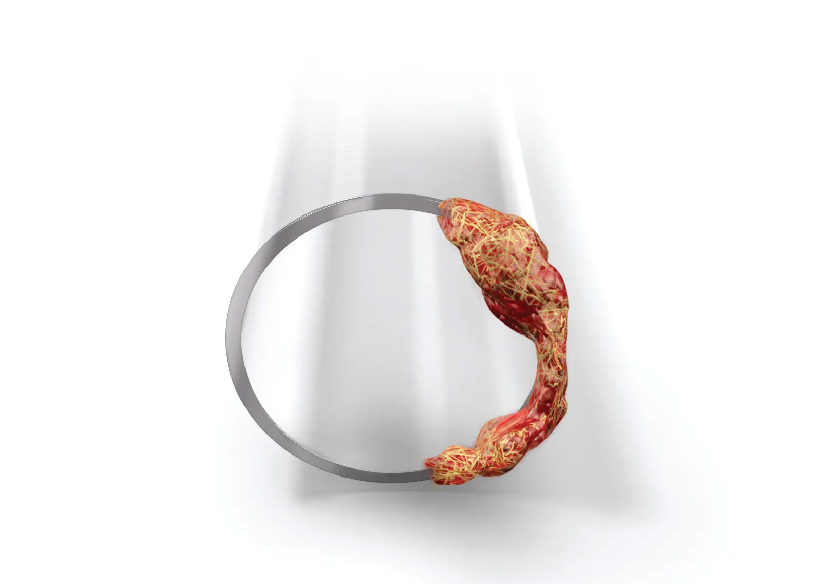 Blood clot obstructing a vessel cross-section, illustrating fibrin-rich thrombus targeted by thrombolytic therapy for stroke and heart attack treatment.