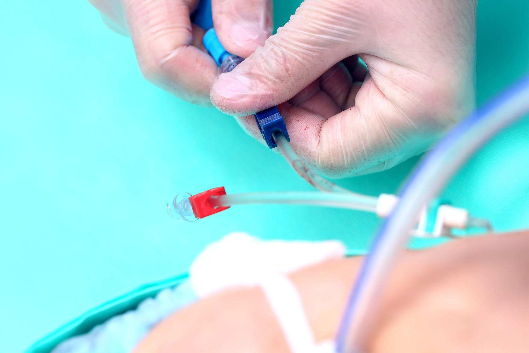 Close-up of healthcare professional administering intravenous catheter for thrombolytic drug delivery in a clinical setting